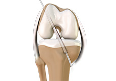 Anterior Cruciate Ligament ACL Reconstruction