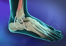 Ankle Ligament Reconstruction