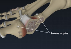 Bunion Surgery