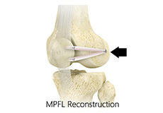 Medial Patellofemoral Ligament Reconstruction